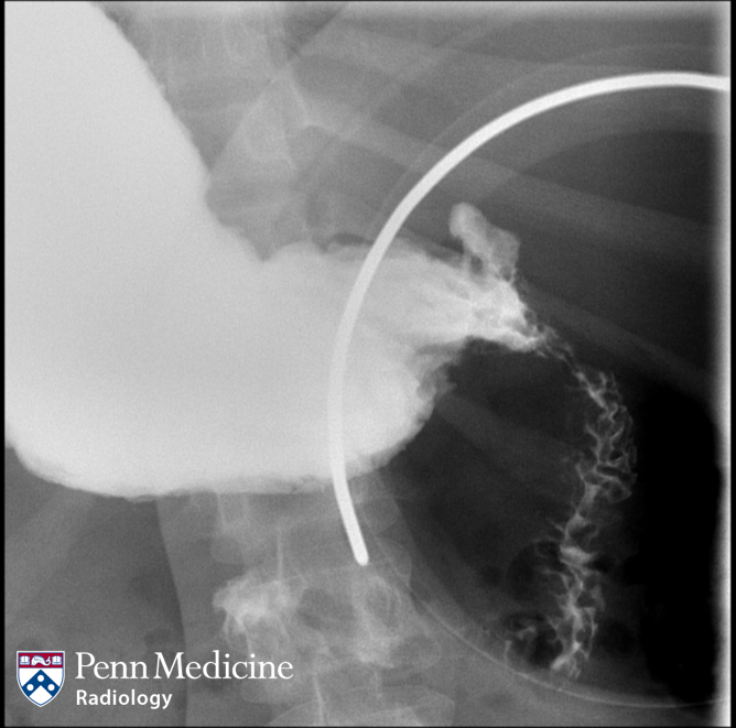 32-year-old woman with nausea, vomiting, early satiety, and bloating after meals