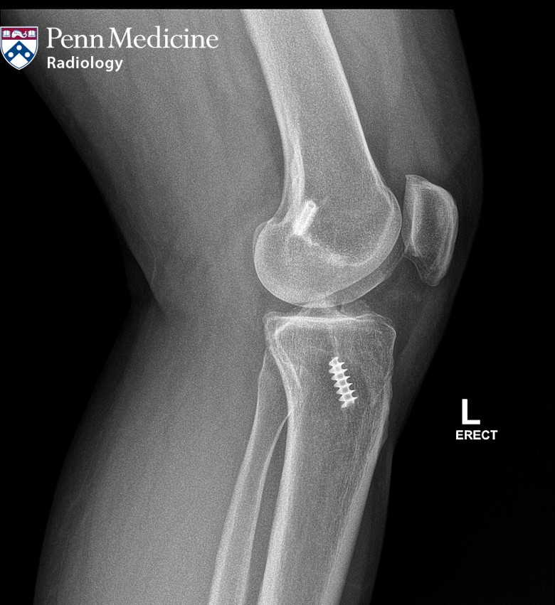 38-year-old woman with left knee pain