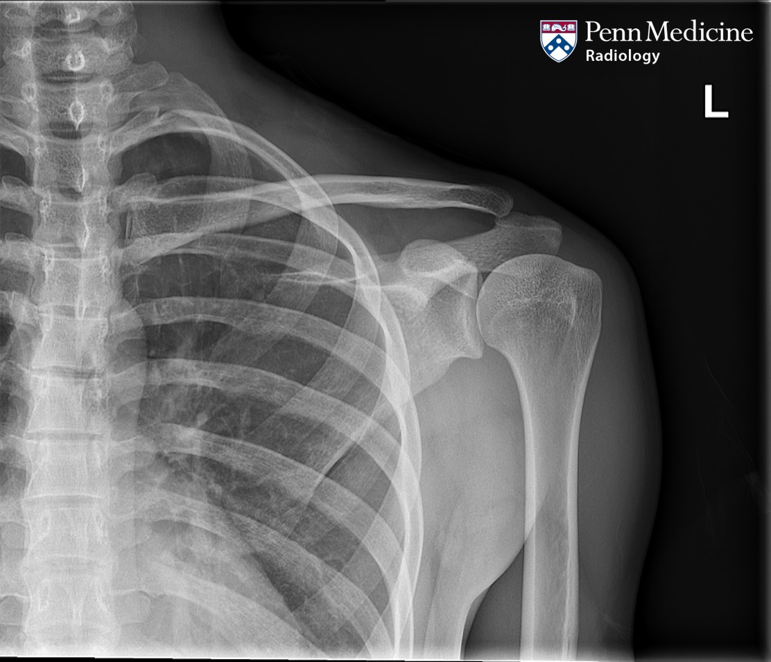 21-year-old woman with chronic left shoulder pain