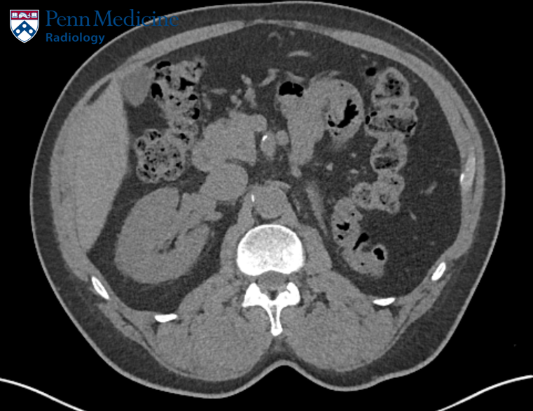 70-year-old man with elevated creatinine
