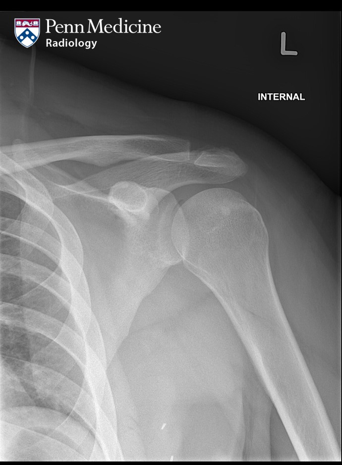 39-year-old woman with chronic shoulder pain