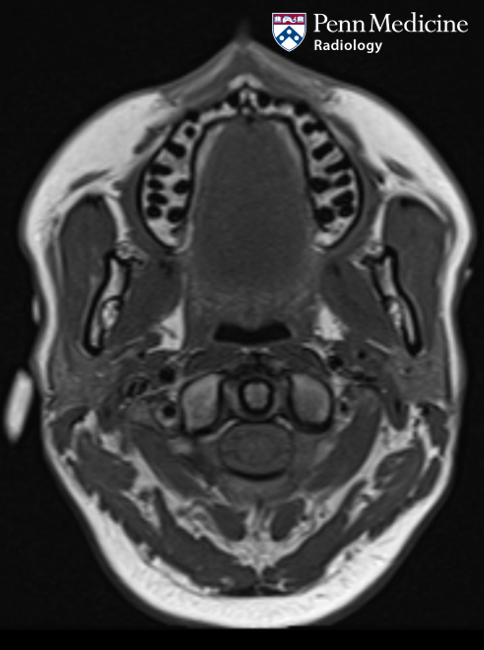 37-year-old woman with dry mouth and mild firmness along both cheeks