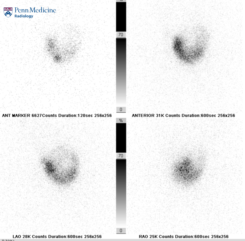 76-year-old woman with neck mass and occasional palpitations