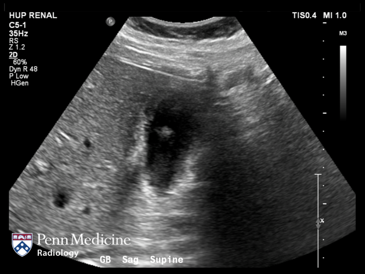 29-year-old woman with right upper quadrant pain