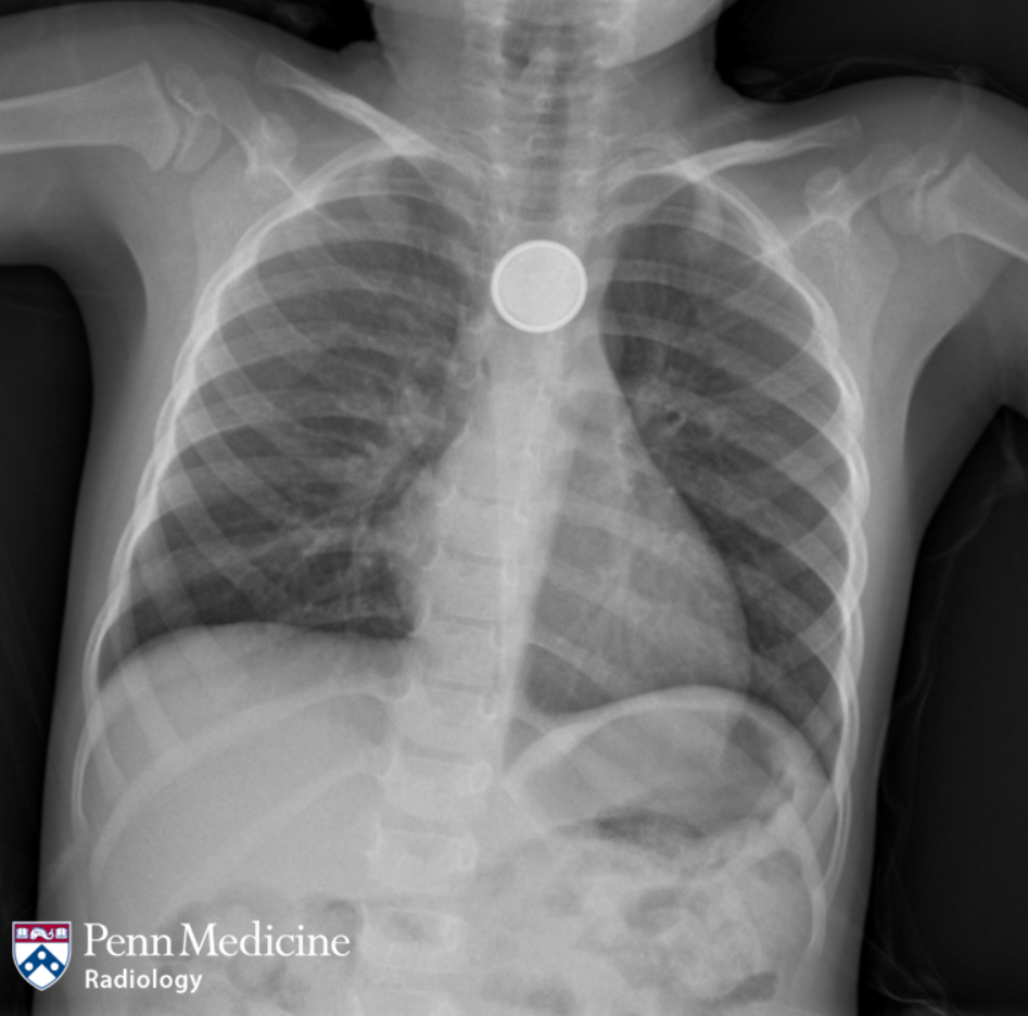 3-year-old girl with foreign-body ingestion