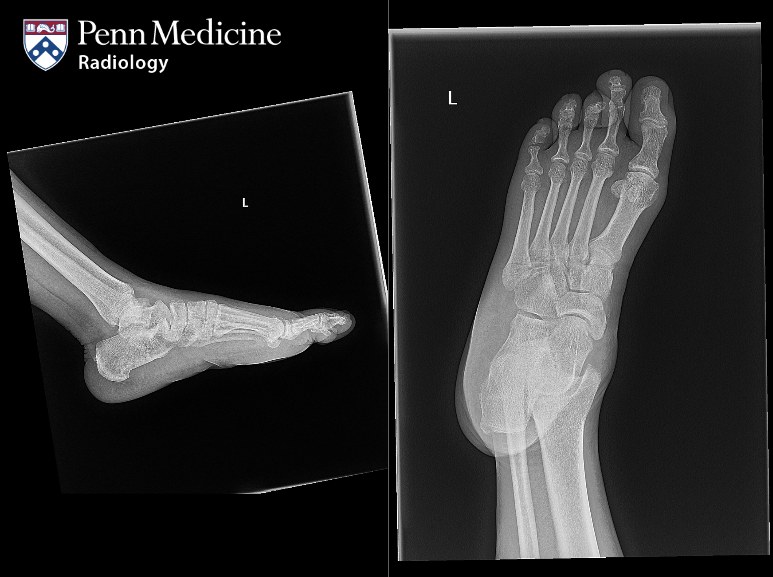 65-year-old woman with residual bilateral foot pain after trip and fall