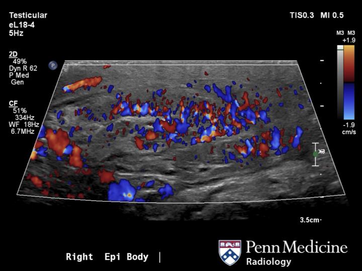 28-year-old man with right testicle pain