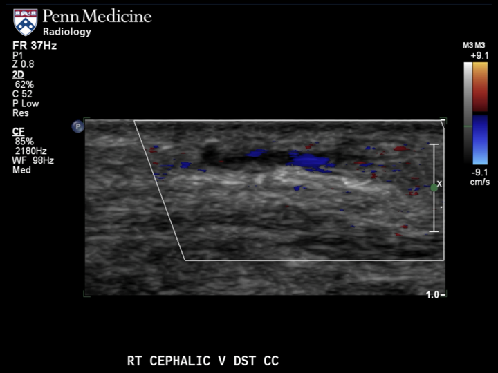 71-year-old man with edema and redness of the right arm