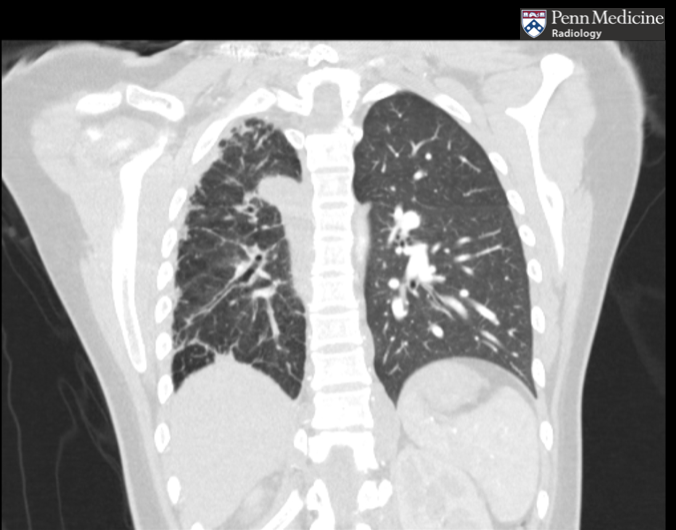 20-year-old woman with dyspnea