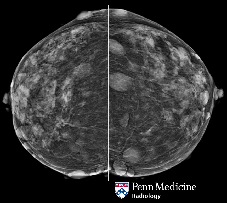 78-year-old woman undergoing screening mammography