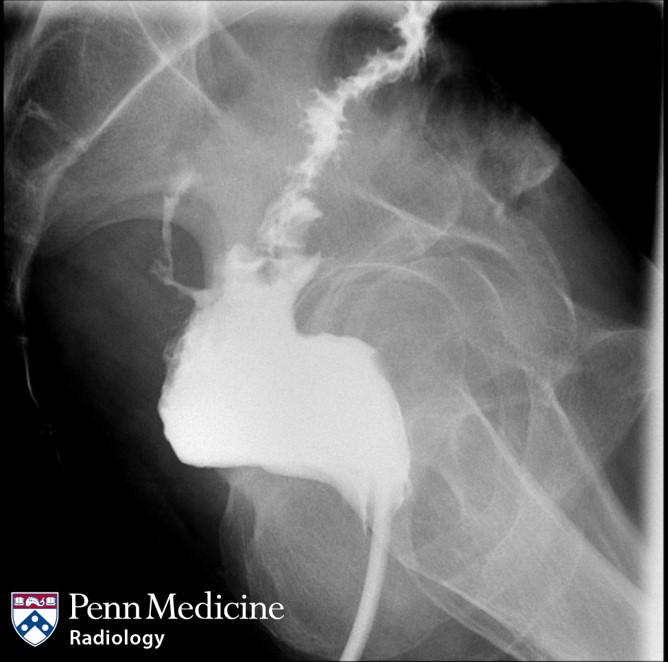 58-year-old man post reversal of Hartmann’s procedure