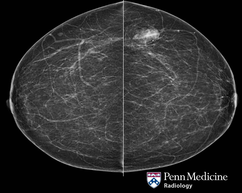 57-year-old woman presents for screening mammography