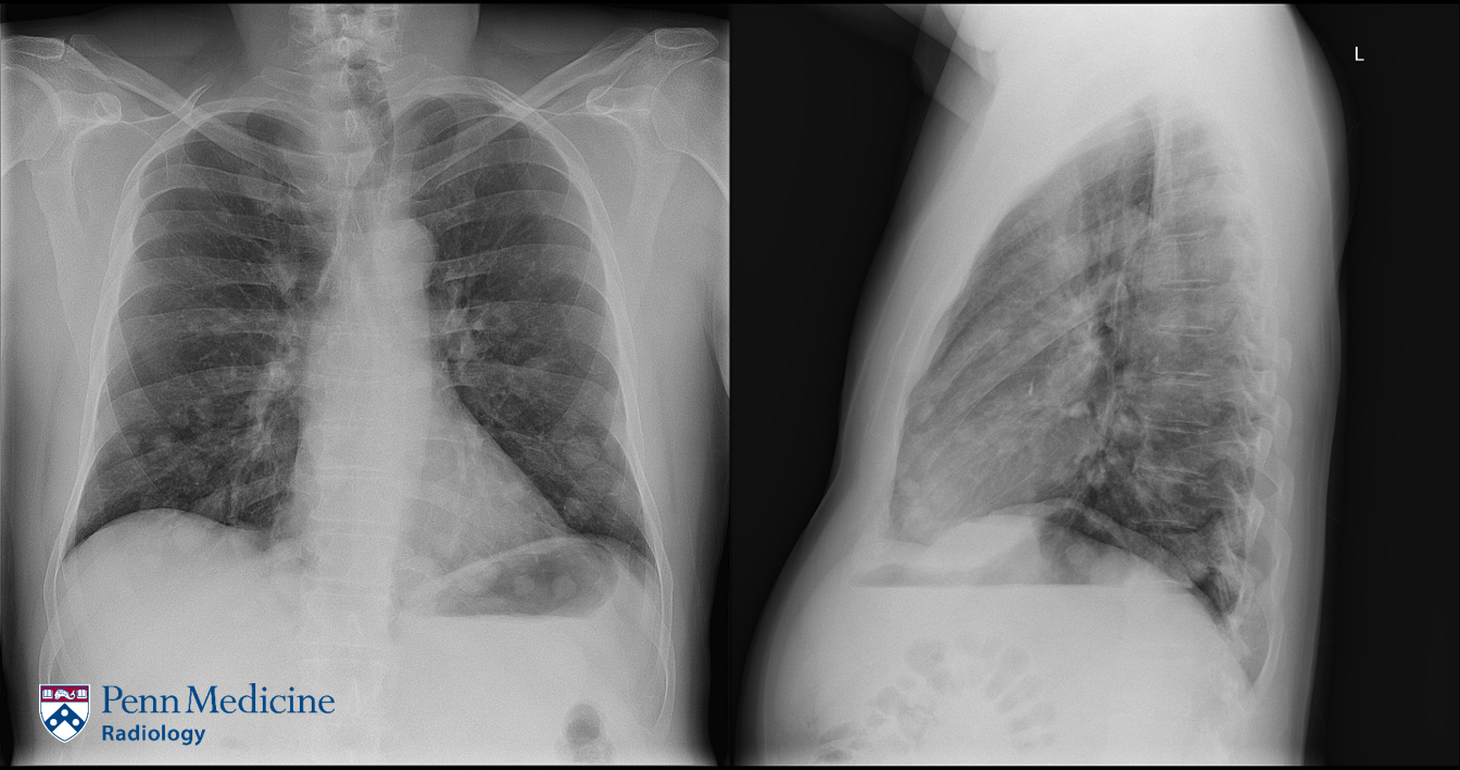 57-year-old man with enlarging neck mass