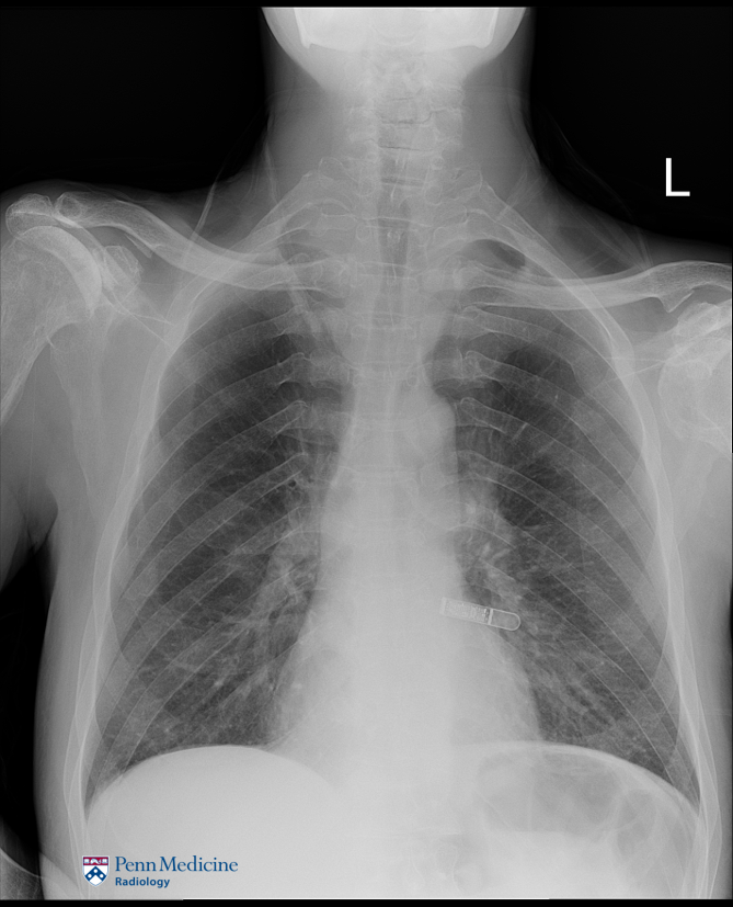 57-year-old man with shortness of breath