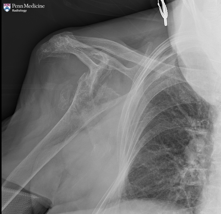 79-year-old woman with right arm swelling