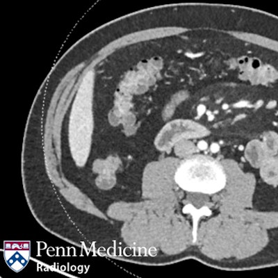 41-year-old man with abdominal pain and nausea
