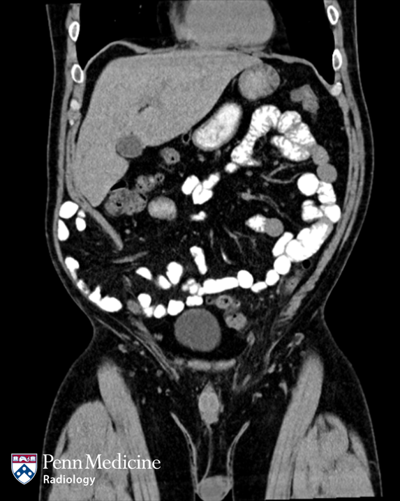 44-year-old man with abdominal pain