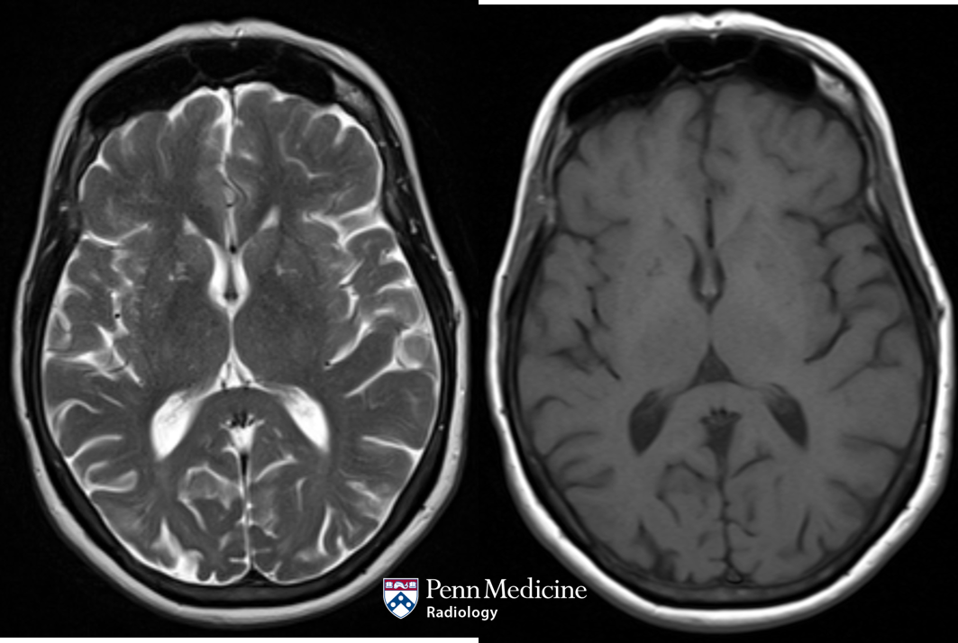 65-year-old woman with new bilateral upper-extremity resting tremors