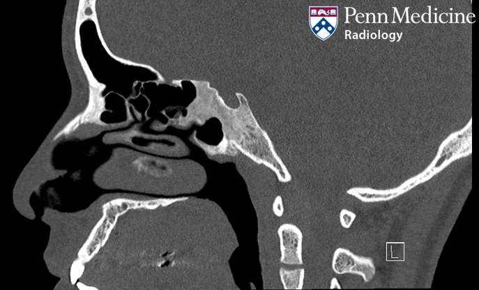 Teenage boy with facial pain and headache