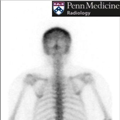 43-year-old woman with history of breast cancer