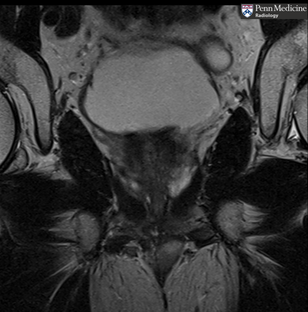 72-year-old man with high-risk prostate adenocarcinoma