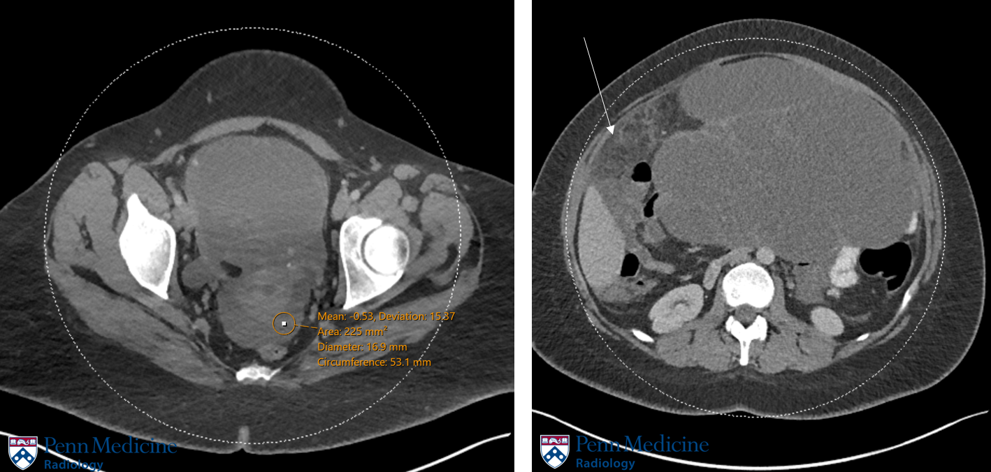 35-year-old woman with seven months of progressive abdominal pain