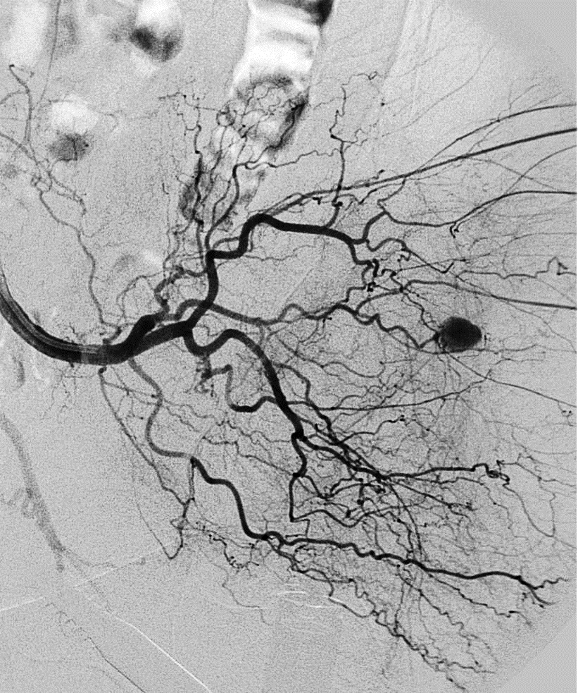 91-year-old woman with left hip pain after falling