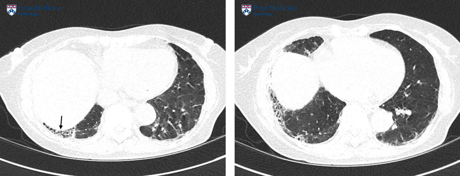 72-year-old woman with shortness of breath