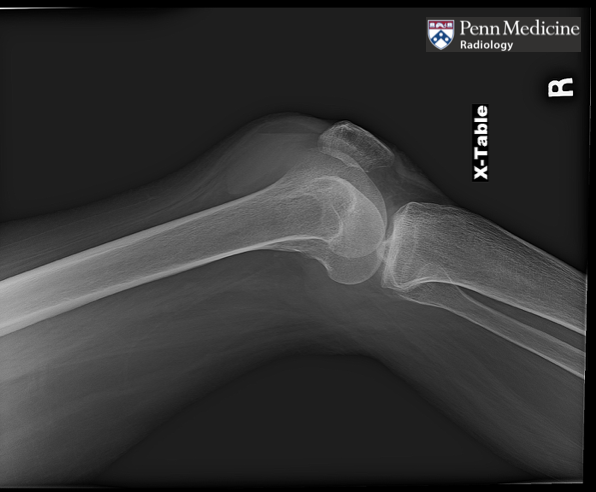 64-year-old woman with right knee pain