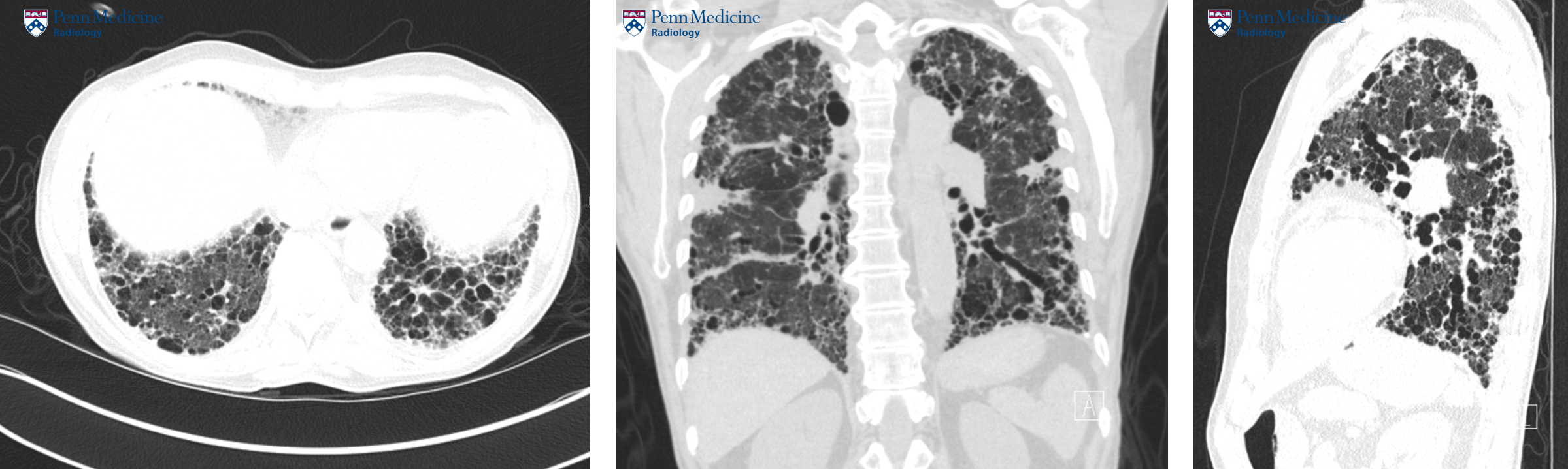 69-year-old man with chronic cough and shortness of breath
