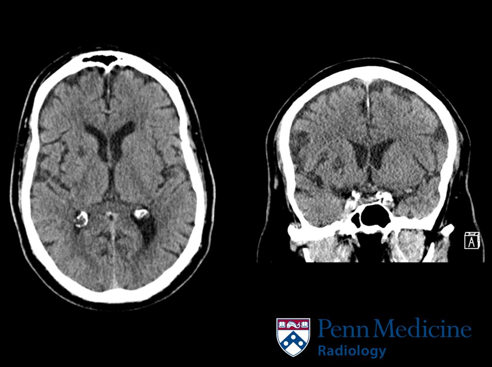 65-year-old woman with abnormal left arm movements