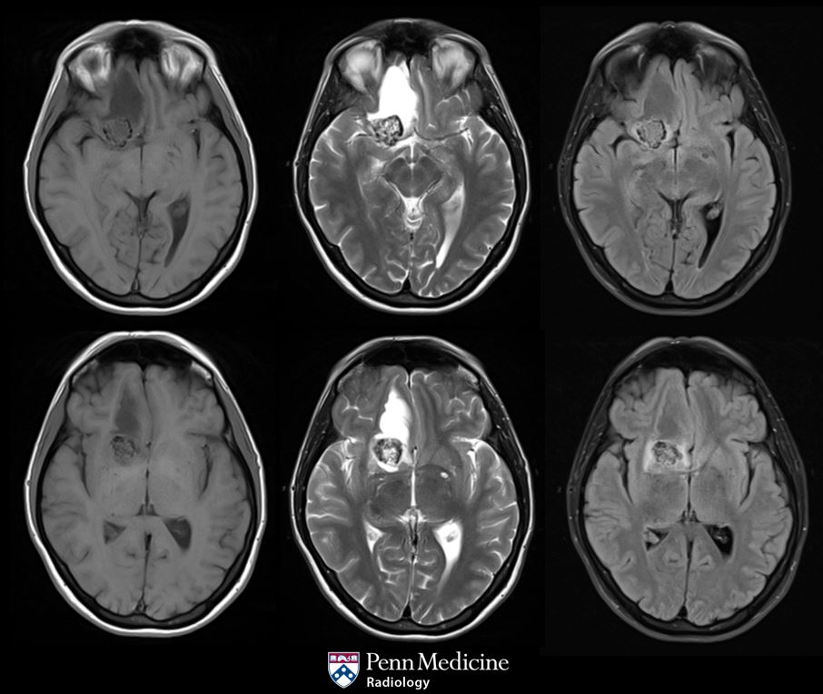 36-year-old woman with increasing headaches