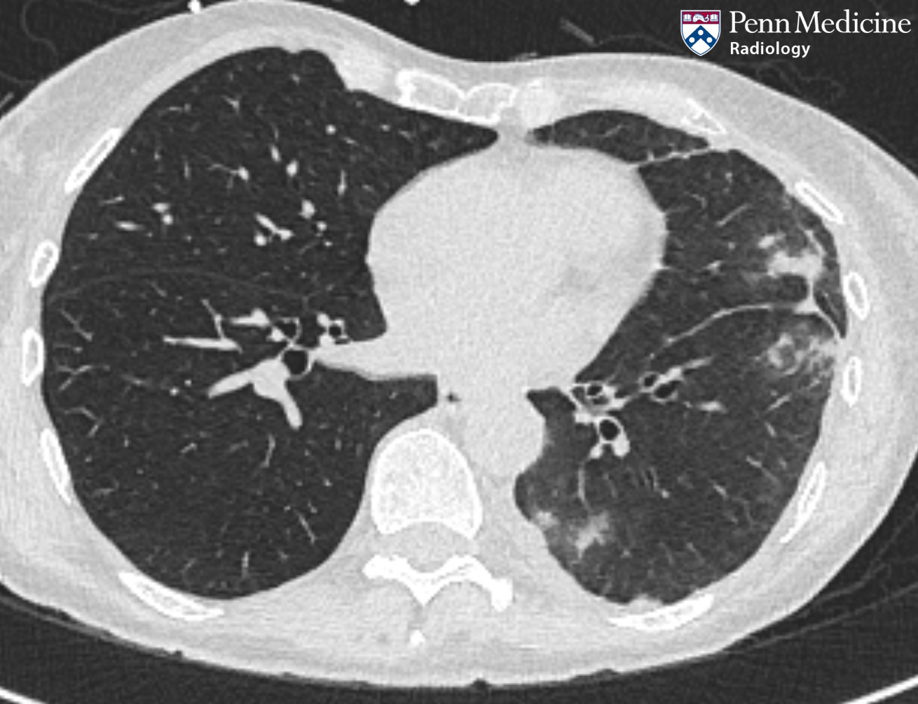 60-year-old woman with left-sided chest pain and hemoptysis