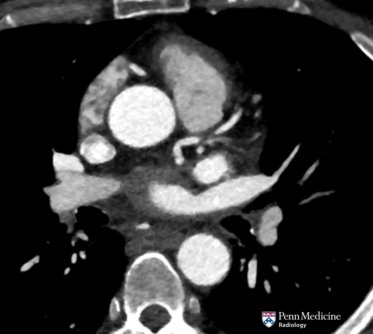 63-year-old woman with severe hypertension and chest pain