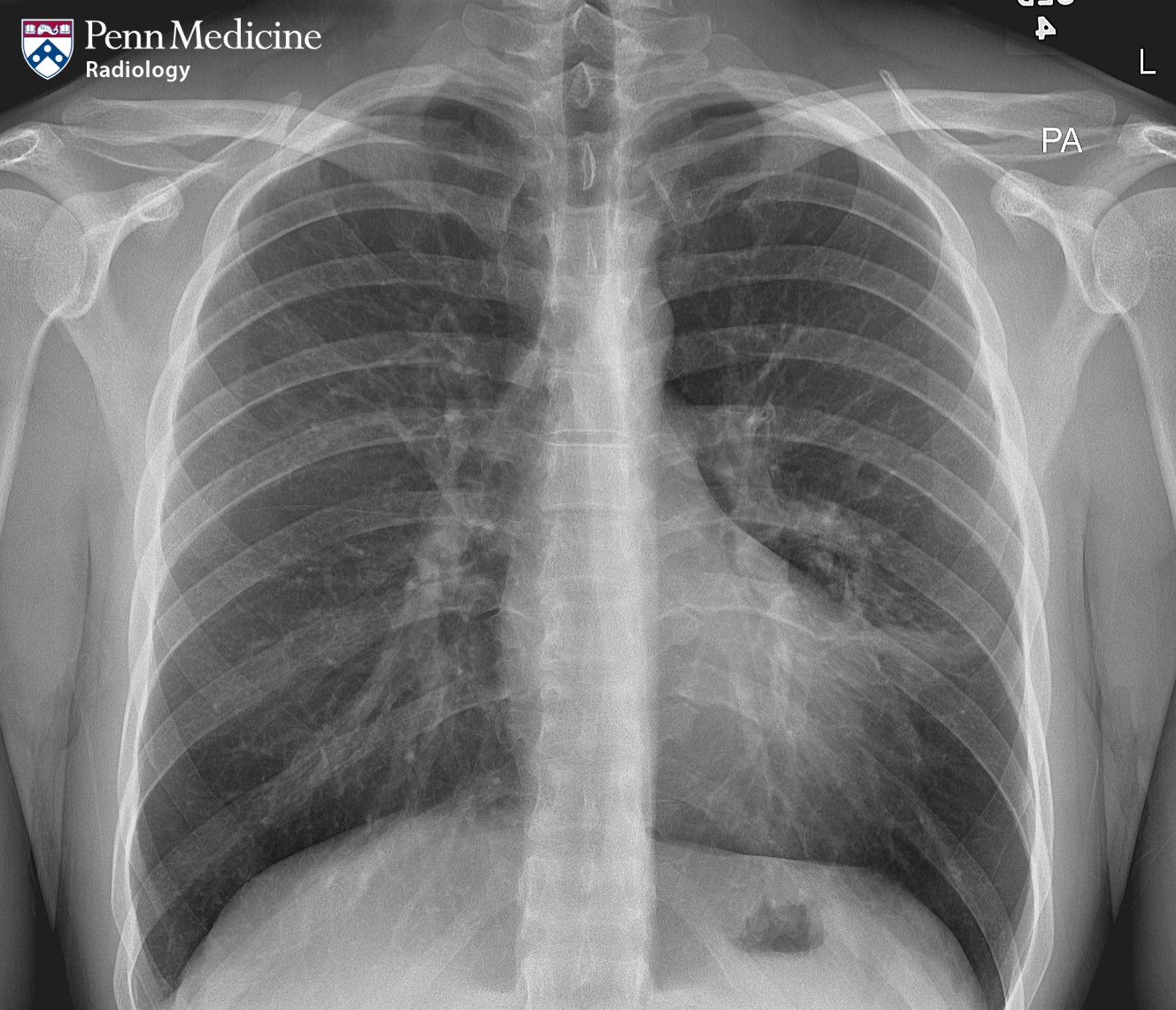 24-year-old man with wheezing and shortness of breath
