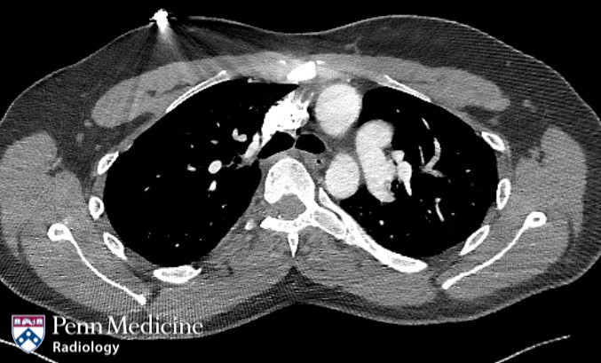 32-year-old woman with intermittent chest pain
