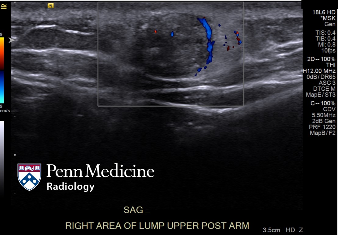 27-year-old man with lump in the right upper arm