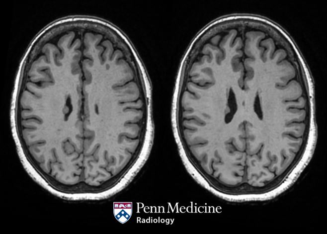 65-year-old woman with headache