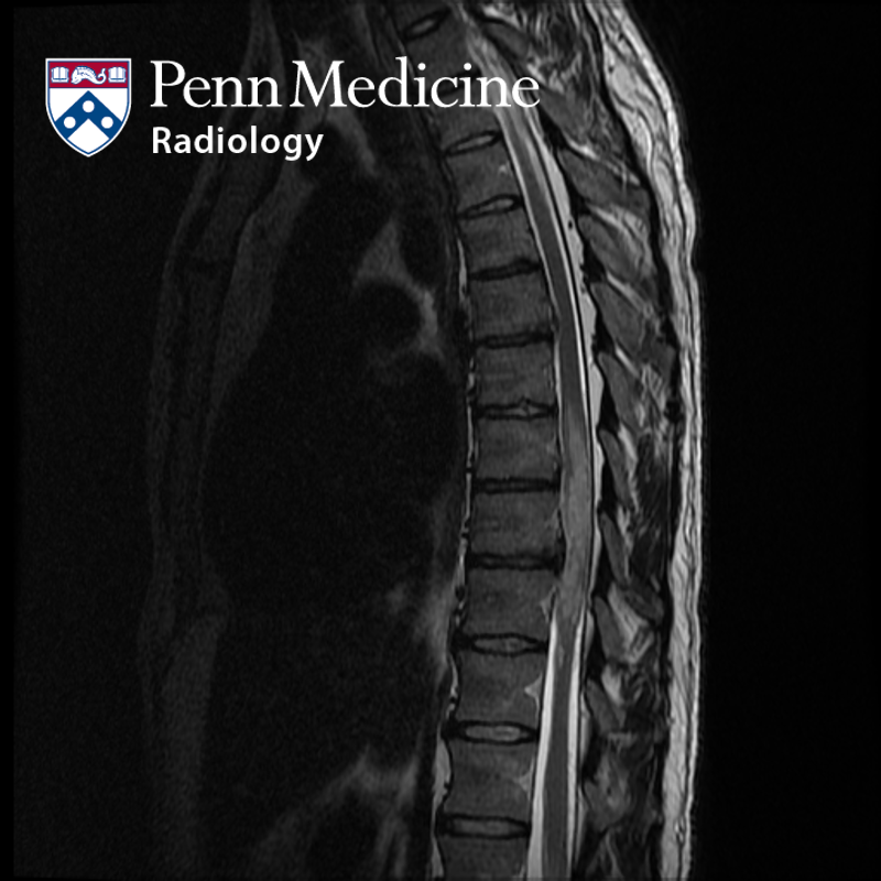 37-year-old man with back discomfort