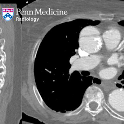 78-year-old woman with sudden-onset chest pain