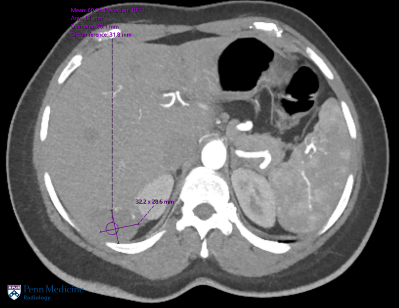42-year-old woman with a suspicious mass on CT