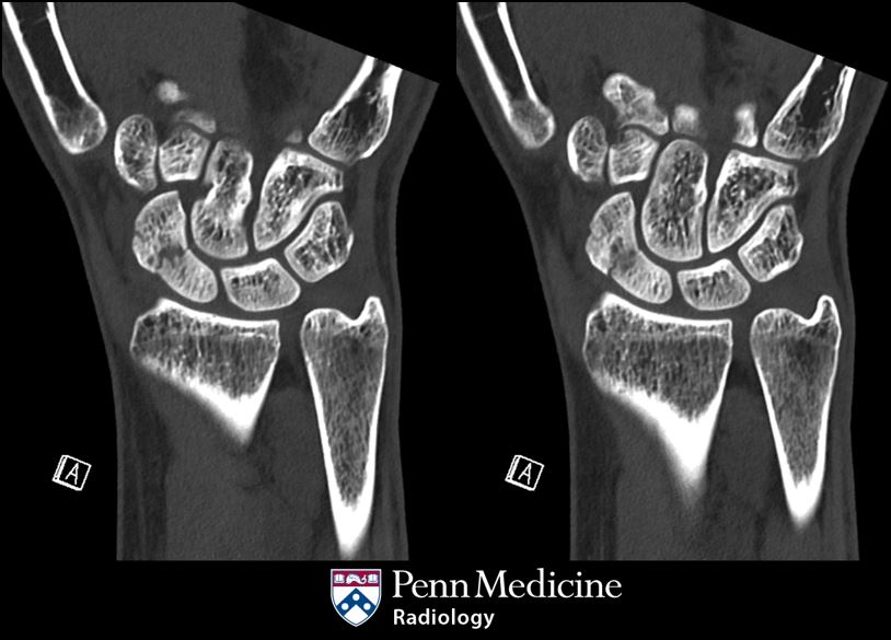 25-year-old woman with wrist pain