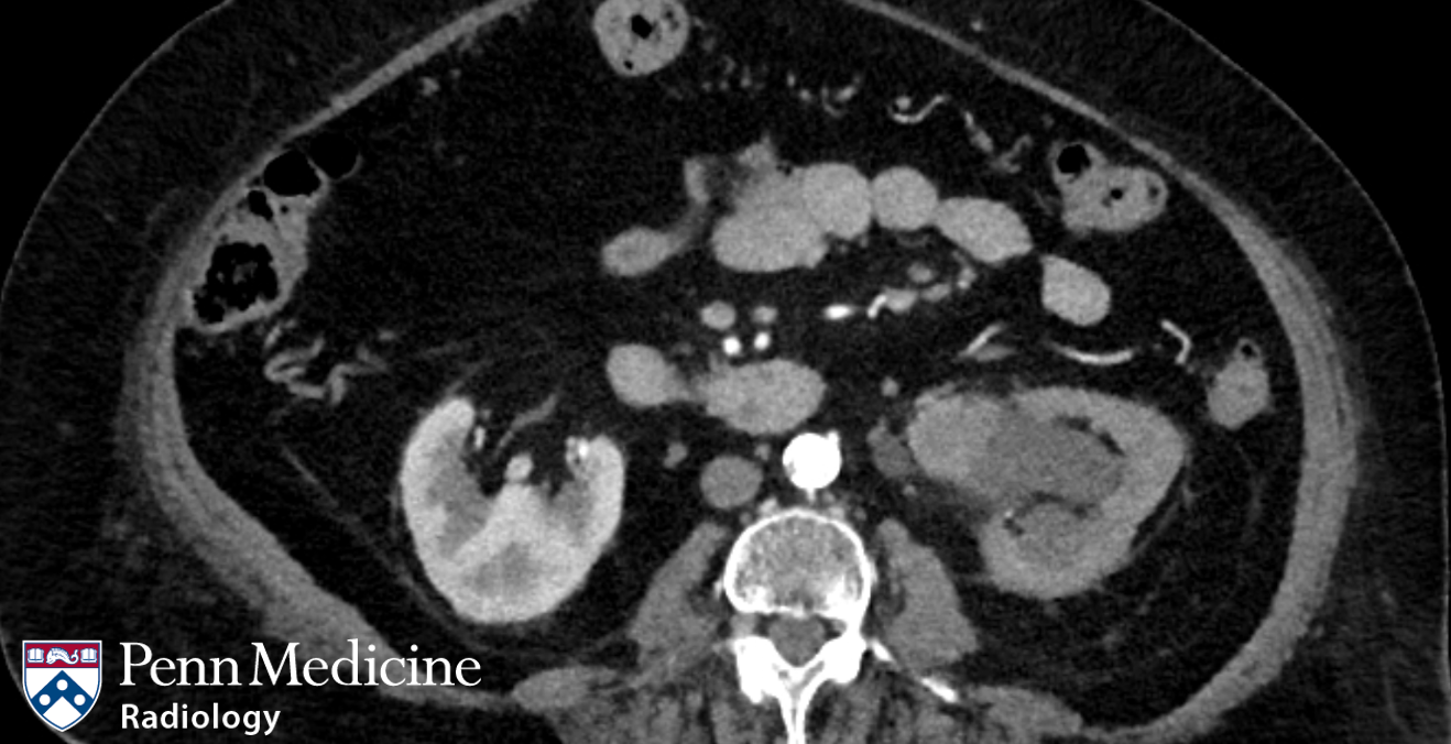 78-year-old woman with gross hematuria