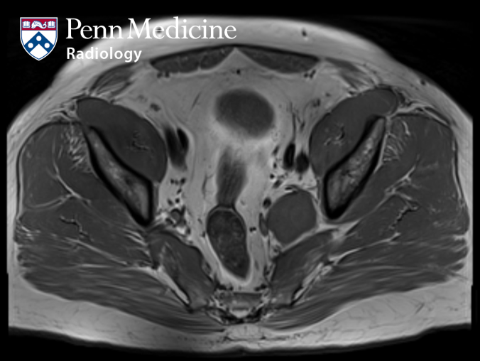 52-year-old man with back pain