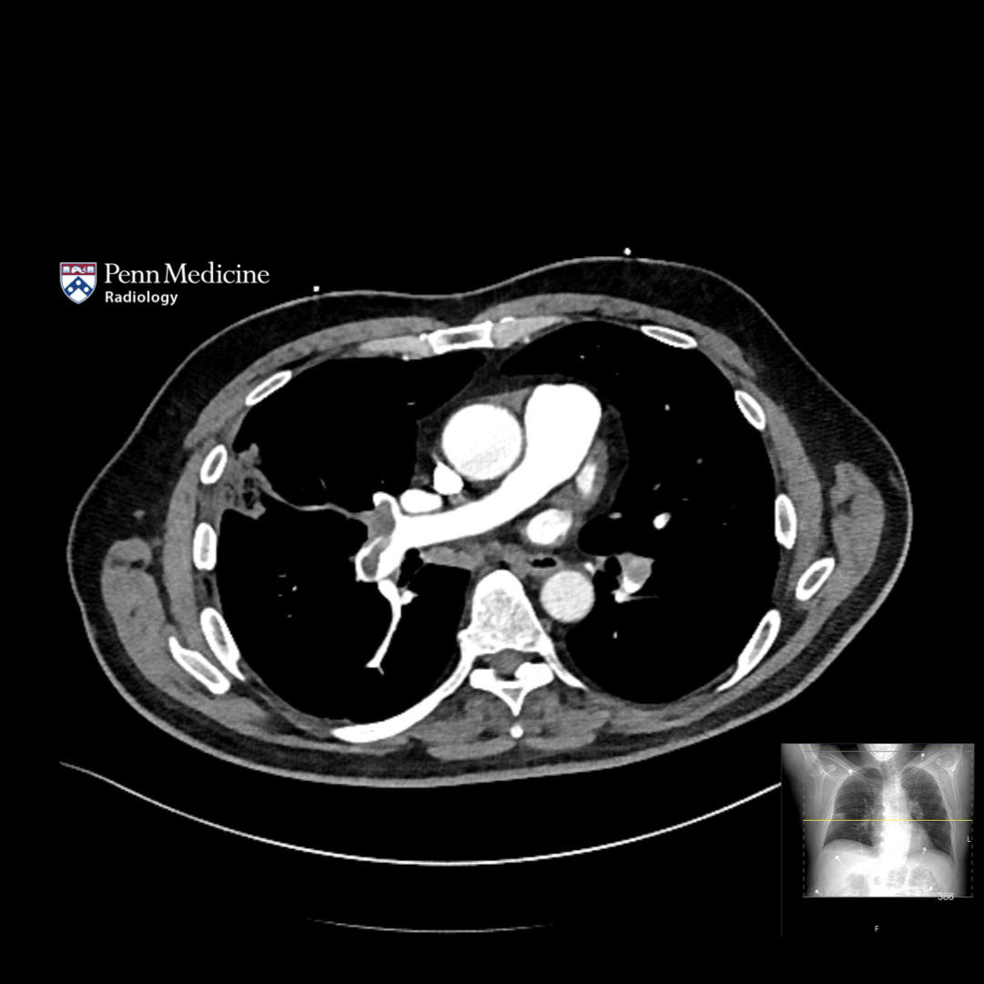59-year-old man presents with chest pain and shortness of breath after recent flight