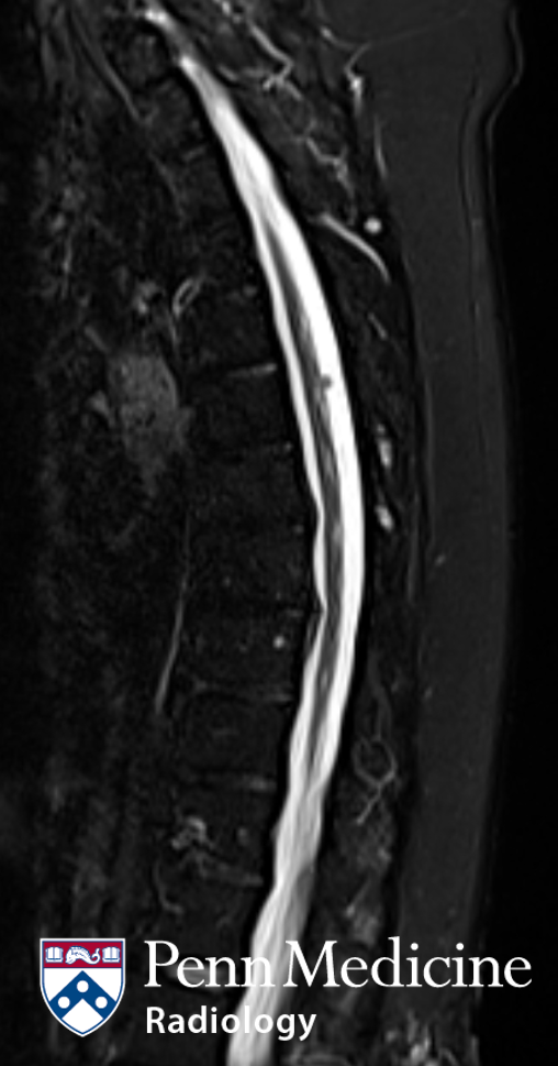 A 72-year-old woman with lower extremity sensory loss