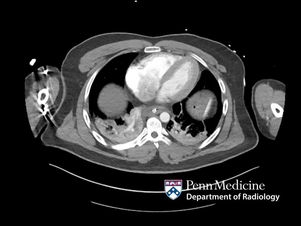 27-year-old man with respiratory failure