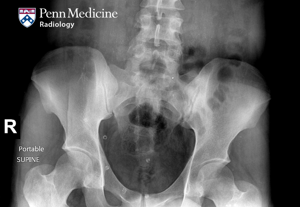 29-year-old man with pelvic pain