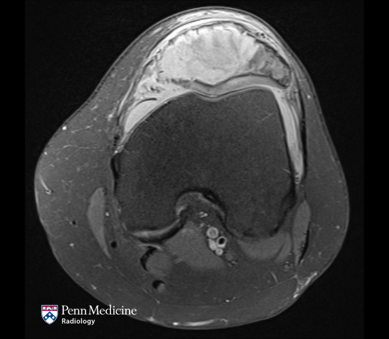 33-year-old woman with knee pain