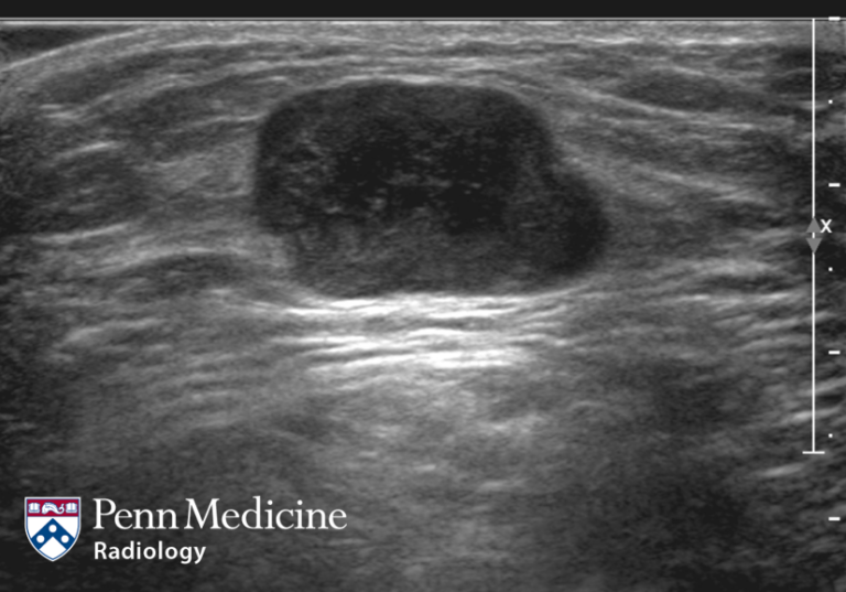 28-year-old woman with a thigh lump
